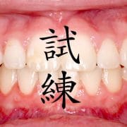 留学している学生の中で世界一歯並びが悪いのは日本人だった。シリーズ「留学の試練」